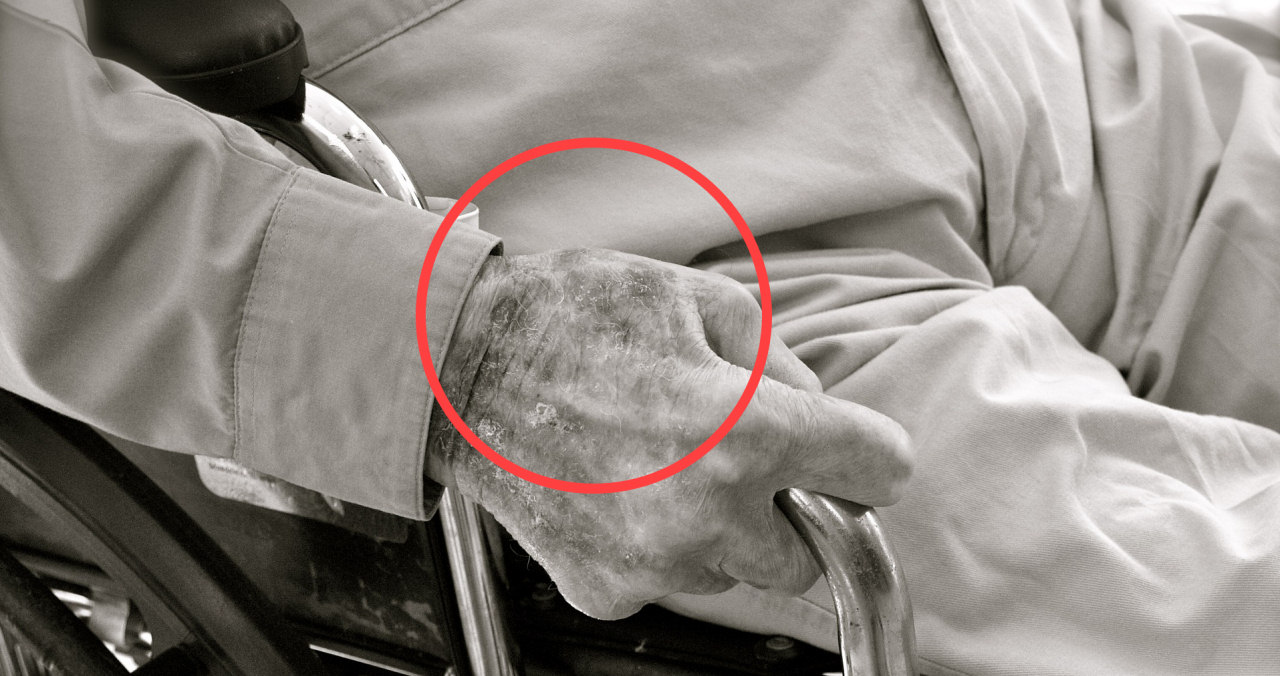 Was Sie gegen Altersflecken damit gegen alternde, lipofuscinreiche Zellen unternehmen sollten: